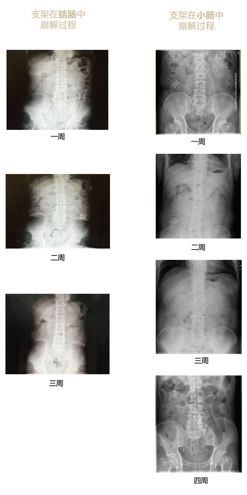 手術(shù)崩解過(guò)程x光片-01.jpg